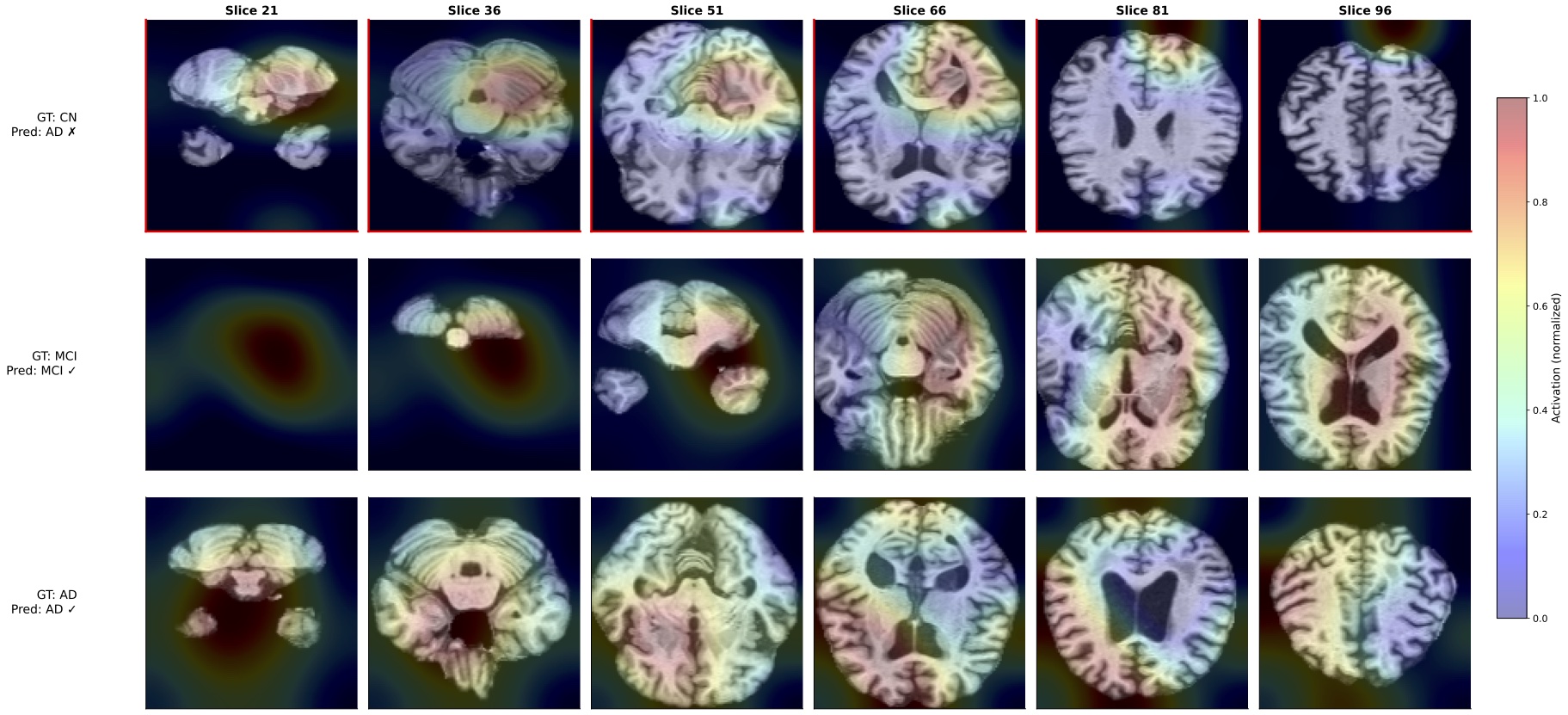 Multimodal cross-attention visualization of Grad-CAM++ for a trained multimodal deep learning model for Alzheimer's prediction on ADNI subjects.