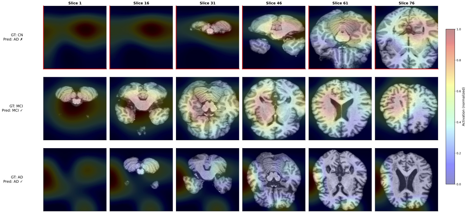 Multimodal cross-attention visualization of Grad-CAM++ for a trained multimodal deep learning model for Alzheimer's prediction on OASIS-3 subjects.