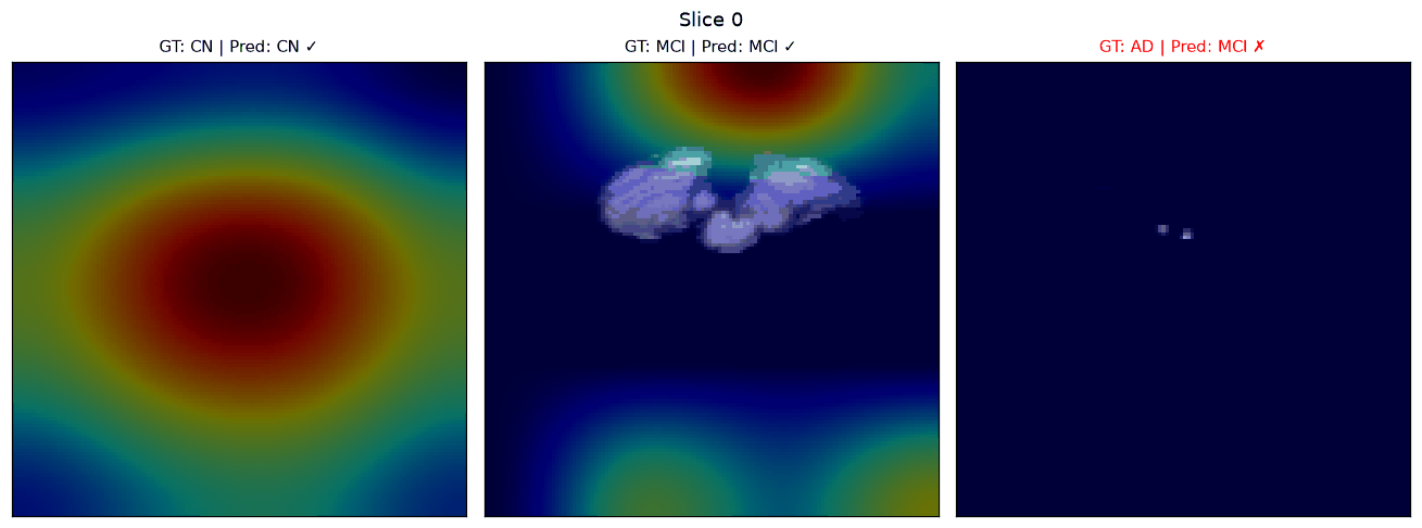 Multimodal cross-attention visualization of Grad-CAM++ for a trained multimodal deep learning model for Alzheimer's prediction on ADNI subjects.
